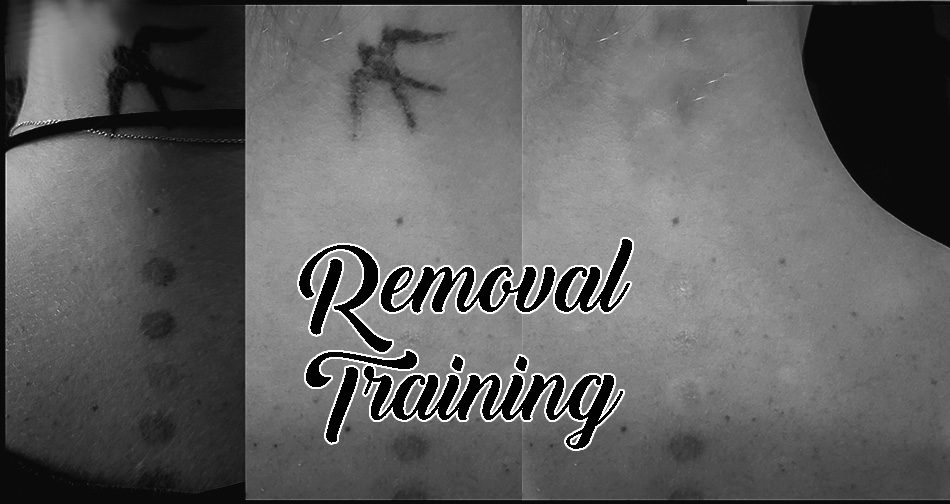 Tattoo Removal as a Business