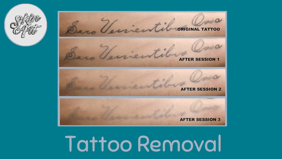 Tattoo Removal Course Training Center Dubai | KHDA Approved Academy