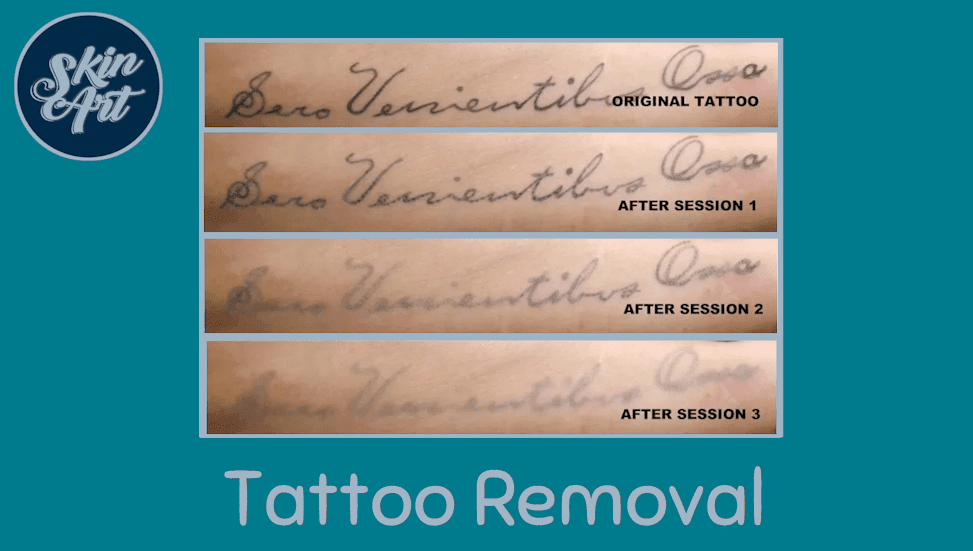 Best Tattoo Removal Treatments in Marshland, Christchurch | Fresha